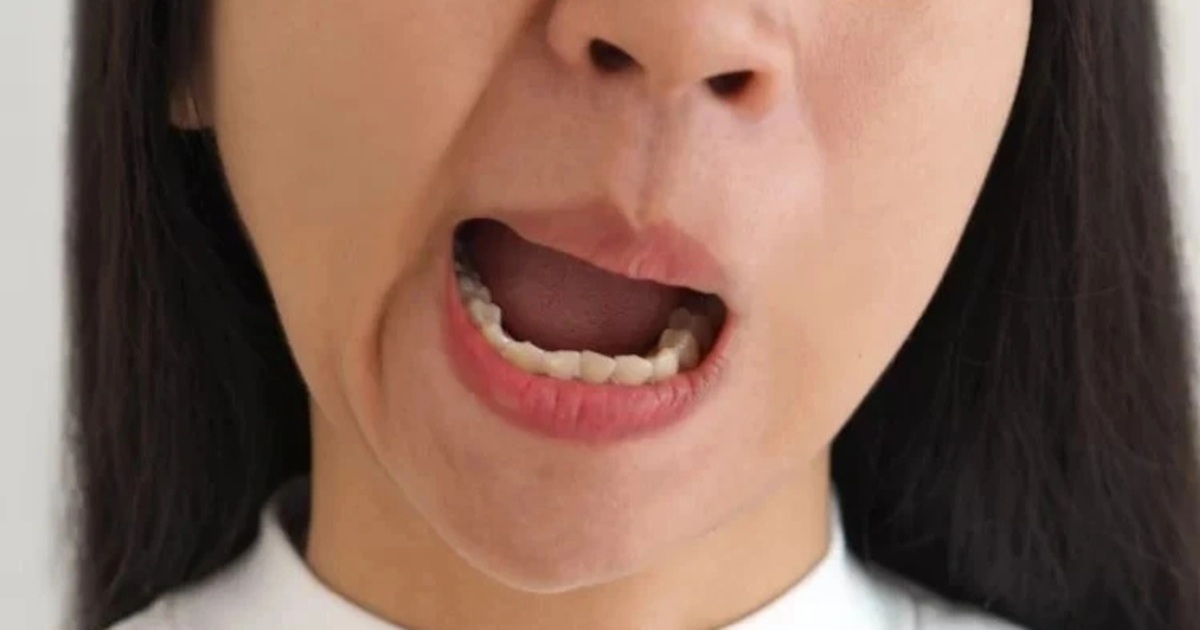 Liệt mặt sau một đêm, người phụ nữ suýt mang di chứng vì chữa mẹo