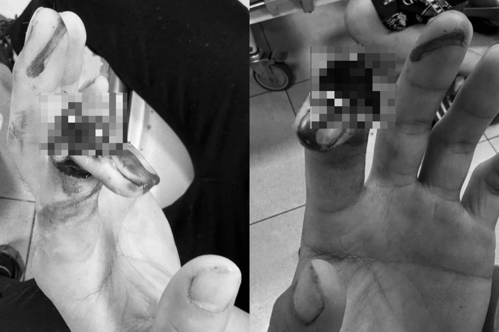 Mang găng tay quá rộng, nam thanh niên gặp tai nạn đứt ngón trỏ