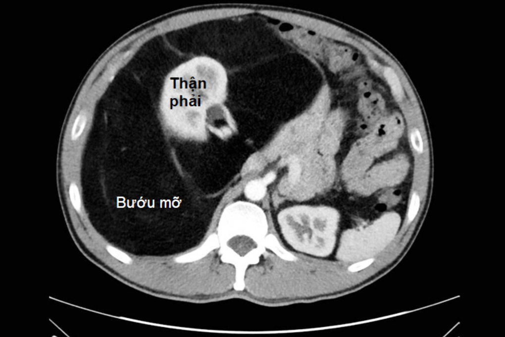 Nhiều người suýt chết vì tưởng “bụng bia”