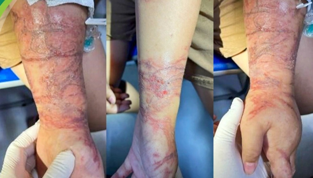 Vòng tay ôm sứa biển trong suốt, bé gái bị bỏng rát chằng chịt 2 cẳng tay
