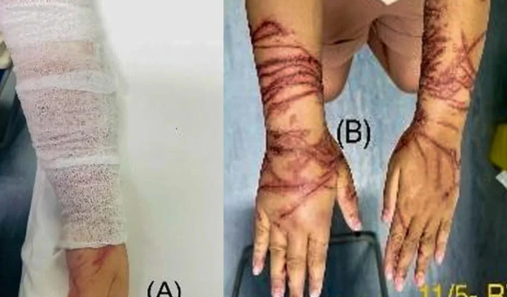 Vòng tay ôm sứa biển trong suốt, bé gái bị bỏng rát chằng chịt 2 cẳng tay - 2