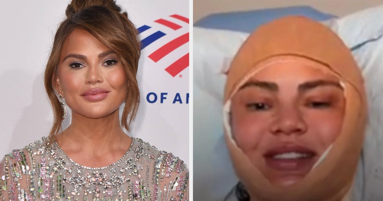 Chrissy Teigen Broke Her Silence After A Photo Of Her Bandaged Face Sparked Concern