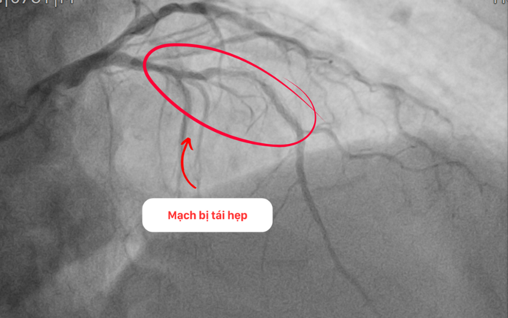 Can thiệp thành công cho bệnh nhân tái hẹp nặng mạch vành sau 15 năm đặt stent