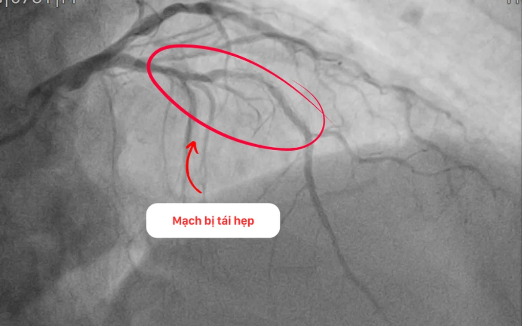 Can thiệp thành công cho bệnh nhân tái hẹp nặng mạch vành sau 15 năm đặt stent - 1