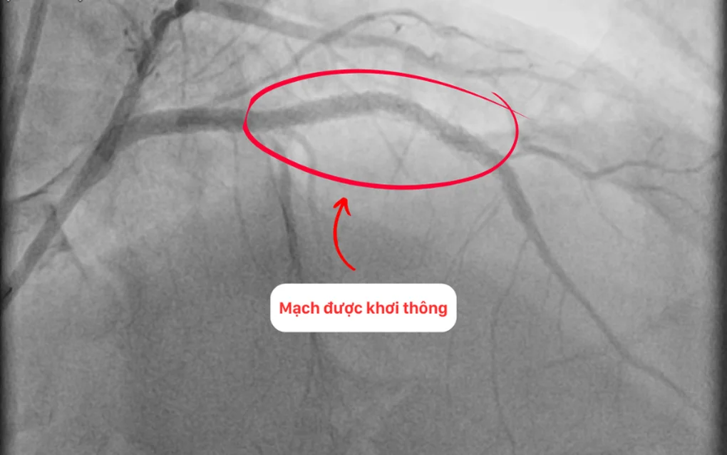 Can thiệp thành công cho bệnh nhân tái hẹp nặng mạch vành sau 15 năm đặt stent - 3