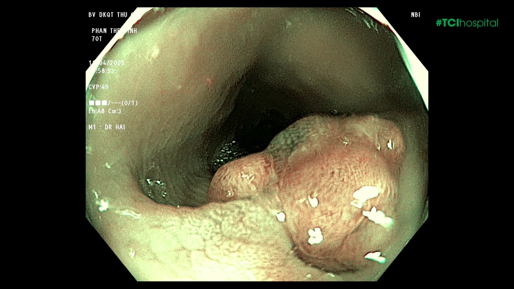 Do dự không cắt 12 polyp đại tràng, bệnh nhân 70 tuổi cấp cứu sau nửa năm