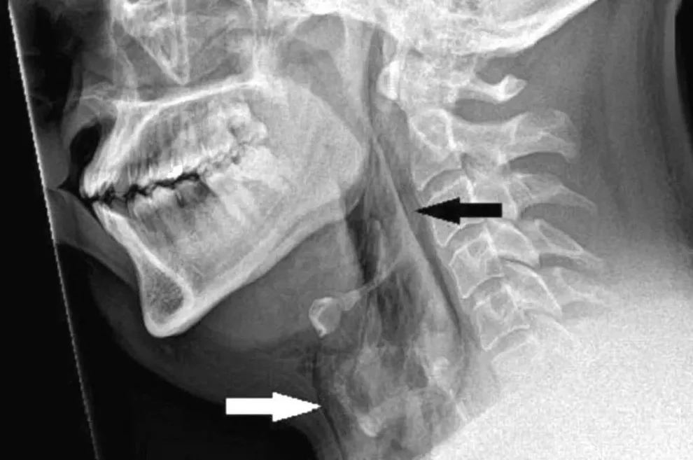 Người đàn ông bị rách khí quản vì cố nhịn hắt hơi - 1