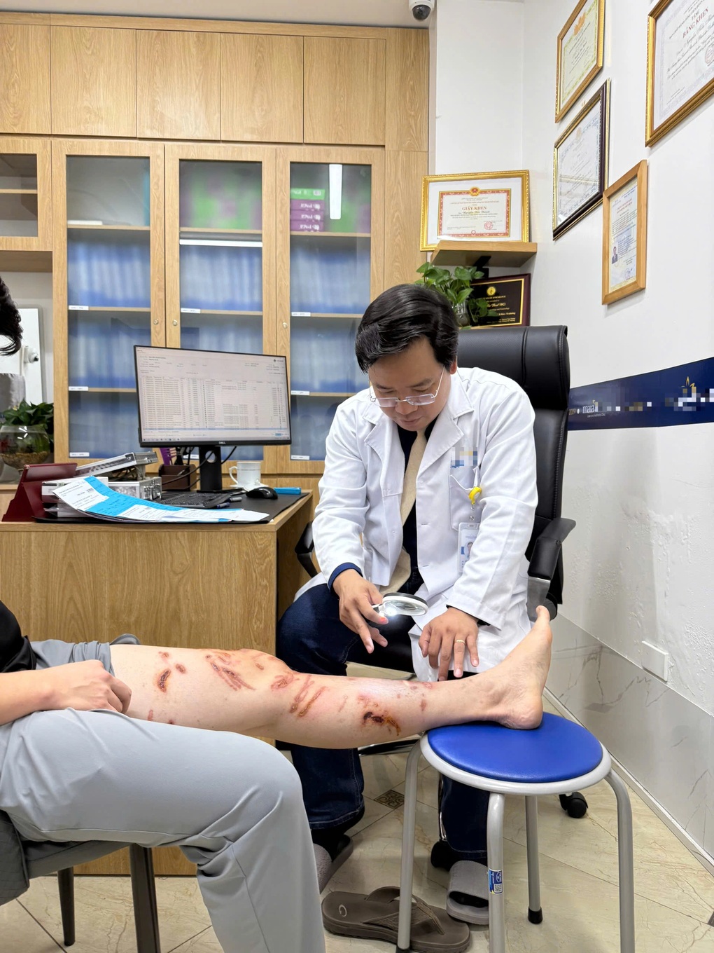 Da loang lổ tổn thương vì bị sứa chích khi tắm biển