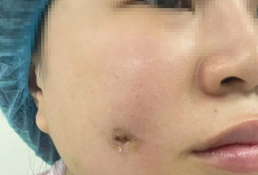 Người phụ nữ bị nhiễm trùng sau khi làm má lúm đồng tiền tại spa