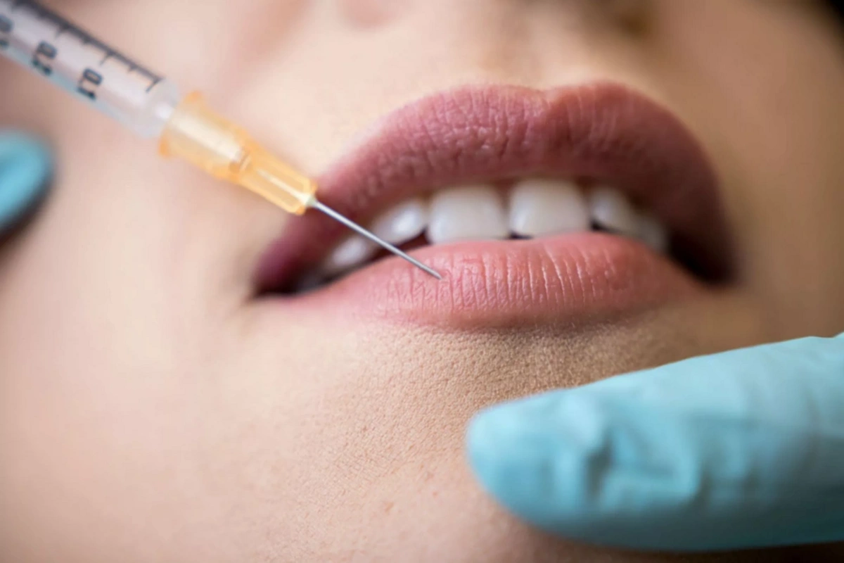 Bloggers are giving up fillers: is the fashion for “perfect beauty” becoming a thing of the past?
