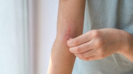 ‘Dupixent-fuelled’ atopic dermatitis market sales to hit $22.4bn by 2033