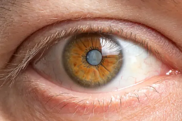 Glaucoma, if untreated, can cause permanent blindness.(Unsplash) Glaucoma, if untreated, can cause permanent blindness.(Unsplash)