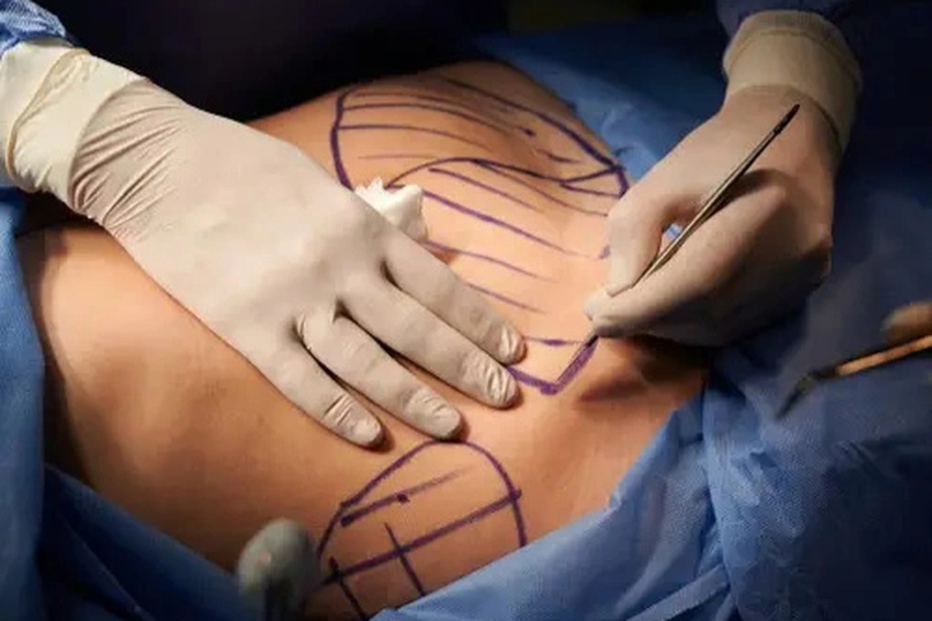 Nam giới chi hàng chục nghìn USD “dao kéo” để có cơ bụng 6 múi