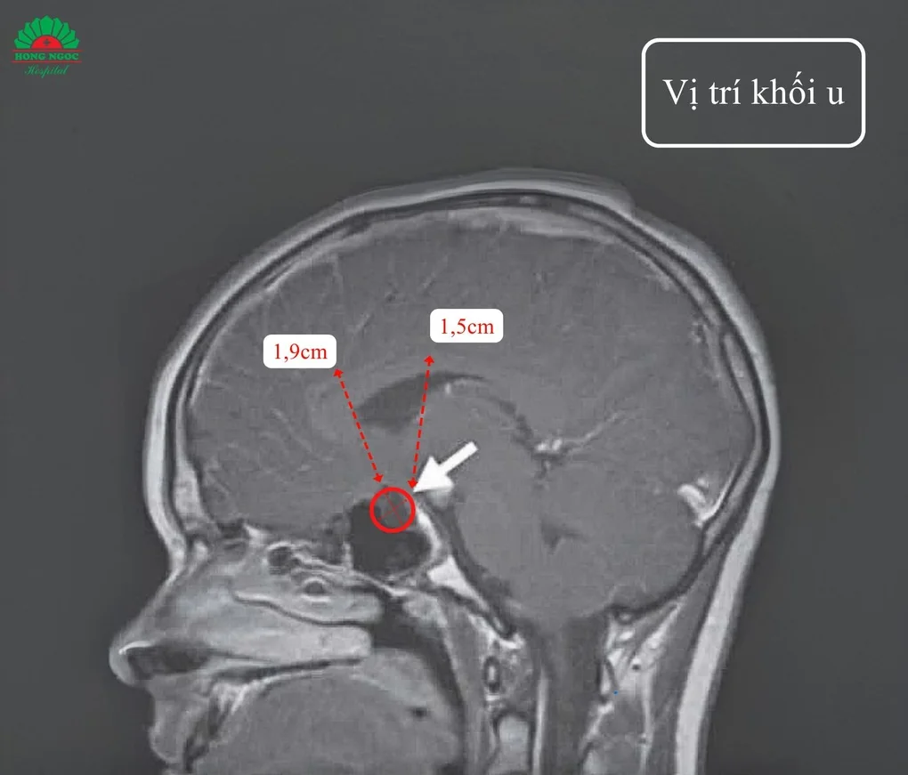 Bé gái 6 tuổi bất ngờ phát hiện khối u vùng não khi tầm soát dậy thì sớm - 2 Bé gái 6 tuổi bất ngờ phát hiện khối u vùng não khi tầm soát dậy thì sớm - 2
