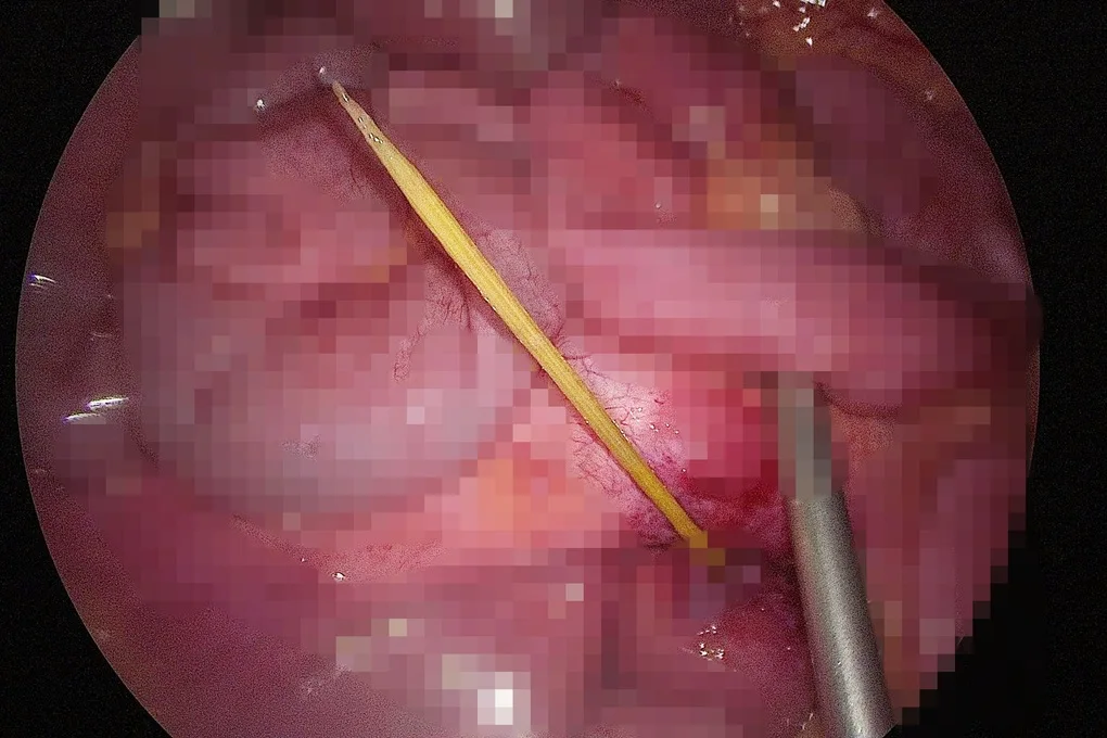Bé trai 14 tuổi lâm nguy vì tai nạn khi vừa ăn, vừa uống nước - 2