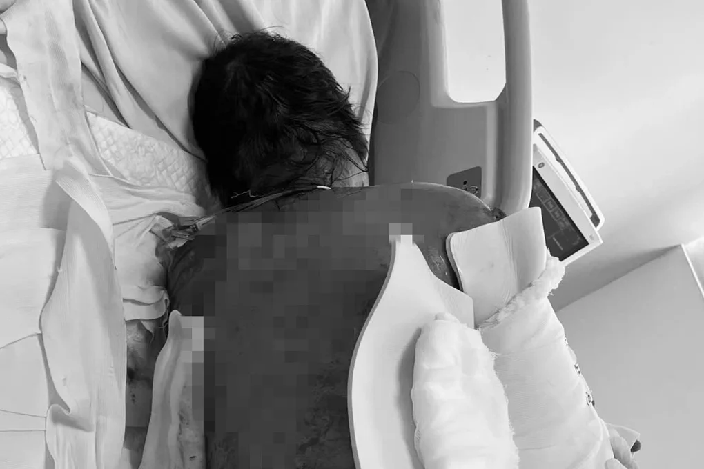 Hội chứng hiểm khiến người phụ nữ bong tróc da 92% sau khi dùng kháng sinh - 1
