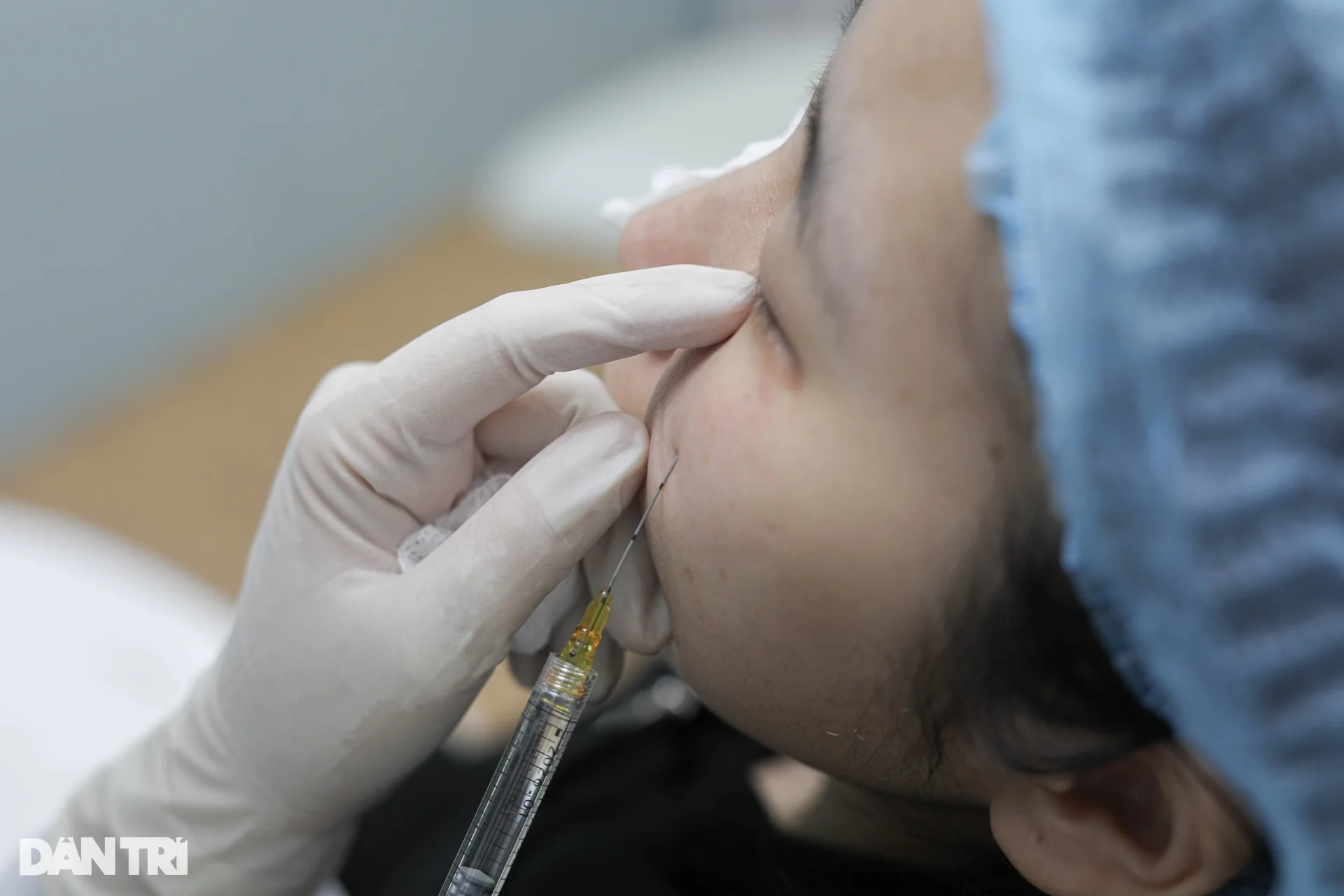 Gen Z chi gần 10 triệu để tiêm filler làm đầy hốc mắt - 10