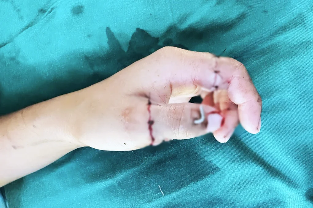 Nhiều trẻ lâm nguy vì đủ loại hiểm họa: Chó cắn vào cổ, liềm cắt đứt tay - 2 Nhiều trẻ lâm nguy vì đủ loại hiểm họa: Chó cắn vào cổ, liềm cắt đứt tay - 2