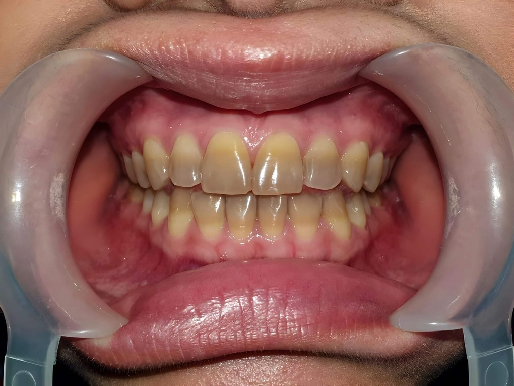 Giải pháp cho răng nhiễm Tetracycline