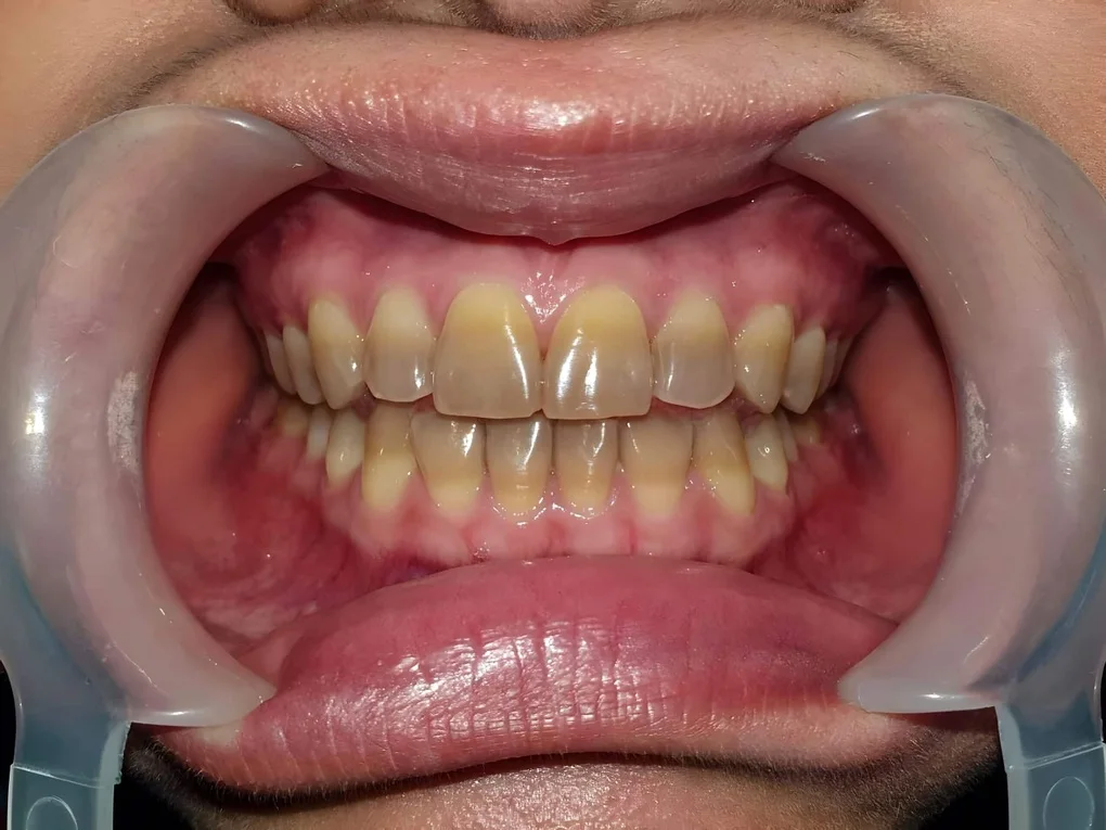 Giải pháp cho răng nhiễm Tetracycline - 1