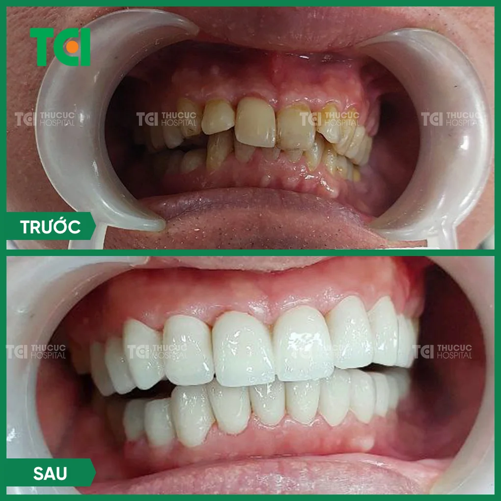 Giải pháp cho răng nhiễm Tetracycline - 3 Giải pháp cho răng nhiễm Tetracycline - 3