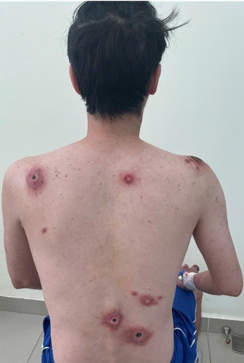Xuất hiện nhiều vết loét trên lưng sau lần “vượt rào” không an toàn