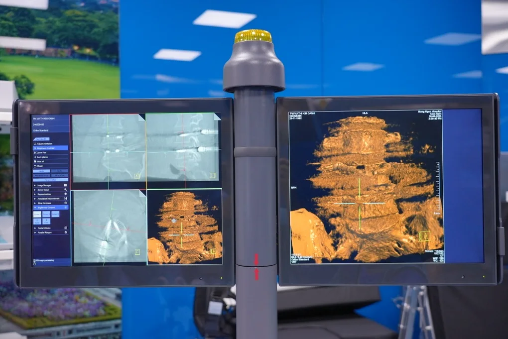 Phẫu thuật thoái hóa cột sống: Hồi phục nhanh, tránh biến chứng nhờ công nghệ C-arm 3D - 4 Phẫu thuật thoái hóa cột sống: Hồi phục nhanh, tránh biến chứng nhờ công nghệ C-arm 3D - 4