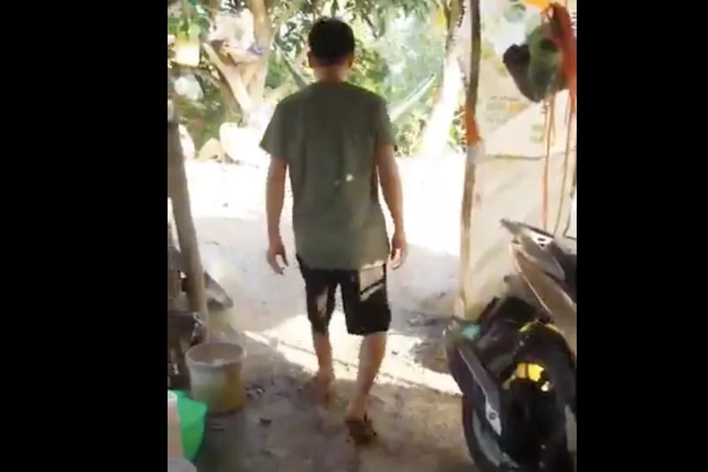 Kỳ diệu: 1 năm sau khi bị tai nạn đứt lìa chân, nam công nhân đã đi được - 2 Kỳ diệu: 1 năm sau khi bị tai nạn đứt lìa chân, nam công nhân đã đi được - 2