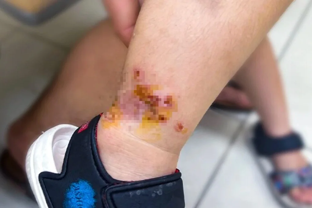Mưa lớn kéo dài, TPHCM tăng mạnh người đi khám da: Bệnh nào nhiều nhất? - 2 Mưa lớn kéo dài, TPHCM tăng mạnh người đi khám da: Bệnh nào nhiều nhất? - 2