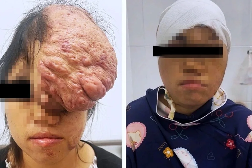 TPHCM: Khẩn cứu 2 phụ nữ mang khối u quái ác ở ruột, xương sọ - 3
