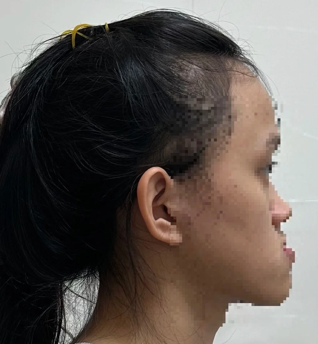 Làm sao xử lý gương mặt lưỡi cày? - 1
