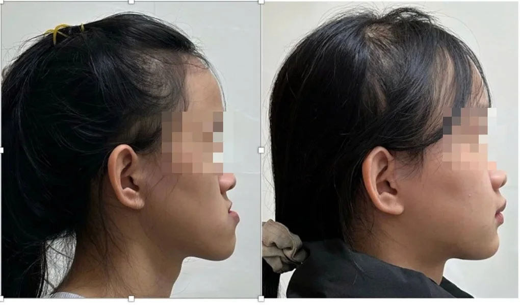 Làm sao xử lý gương mặt lưỡi cày? - 3