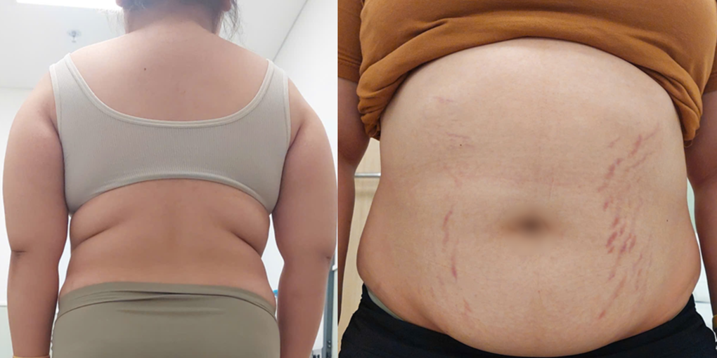 Mắc bệnh hiếm, bé gái 14 tuổi loãng xương, cao huyết áp, sỏi thận, béo phì