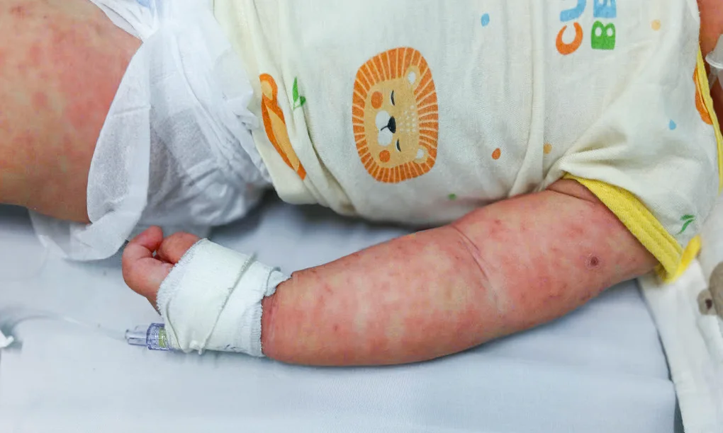 VNVC công bố có thêm vaccine phòng 4 bệnh sởi, quai bị, rubella, thủy đậu - 3