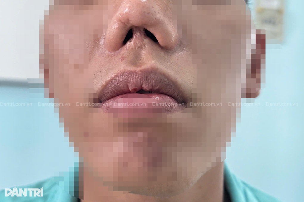 Chàng trai biến dạng mũi 31 năm, chịu nhiều cuộc mổ vì hậu quả lúc sơ sinh