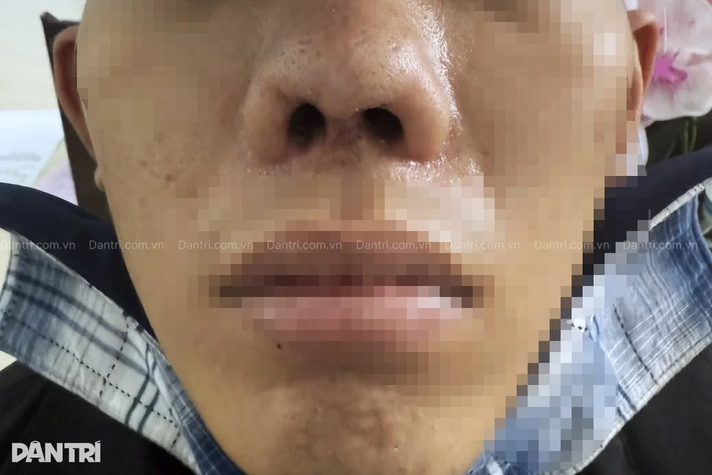 Chàng trai biến dạng mũi 31 năm, chịu nhiều cuộc mổ vì hậu quả lúc sơ sinh - 2