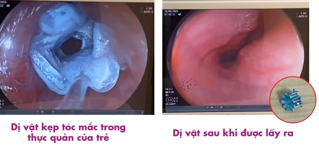 Nuốt phải kẹp tóc, bé gái 5 tuổi nhập viện cấp cứu - 2