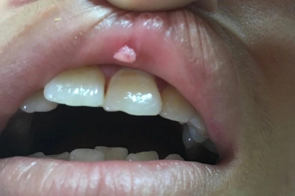 Cô gái mọc sùi mào gà ở miệng