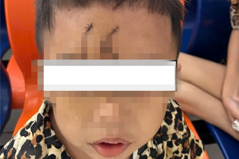 Chơi trước nhà, bé trai 5 tuổi bị chó béc-giê cắn biến dạng mặt nặng nề - 2