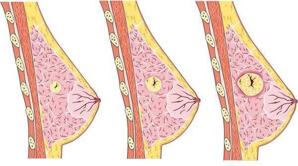 Xử lý dứt điểm tổn thương nghi ngờ ung thư vú không cần mổ