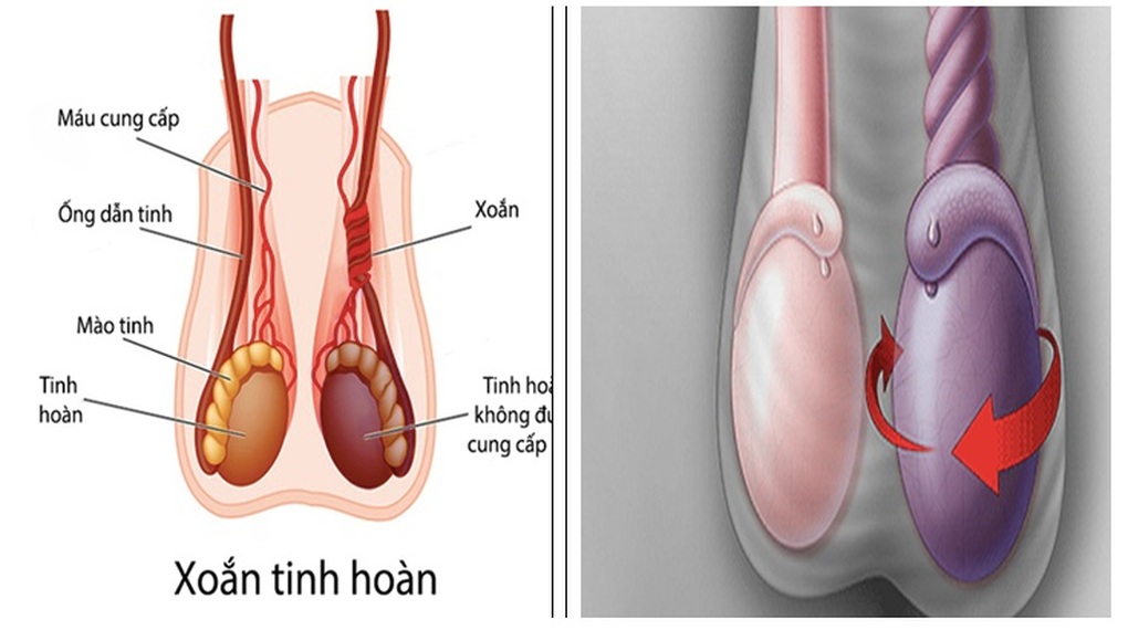 Đột ngột đau dữ dội vùng bìu, chàng trai 20 tuổi may mắn giữ được tinh hoàn