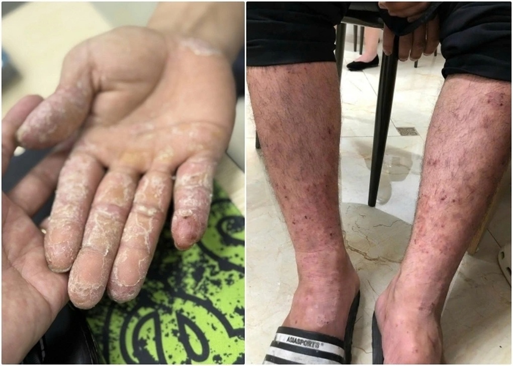 Dấu hiệu trên da ở người sống trong vùng ngập lụt cần chú ý
