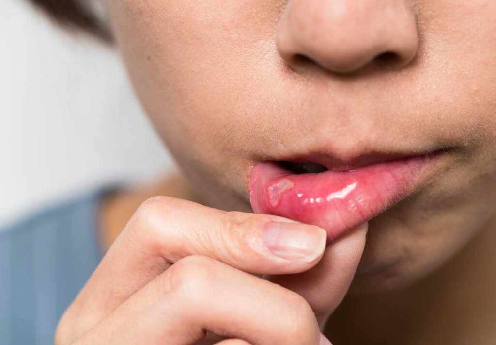 How To Deal With Canker Sores