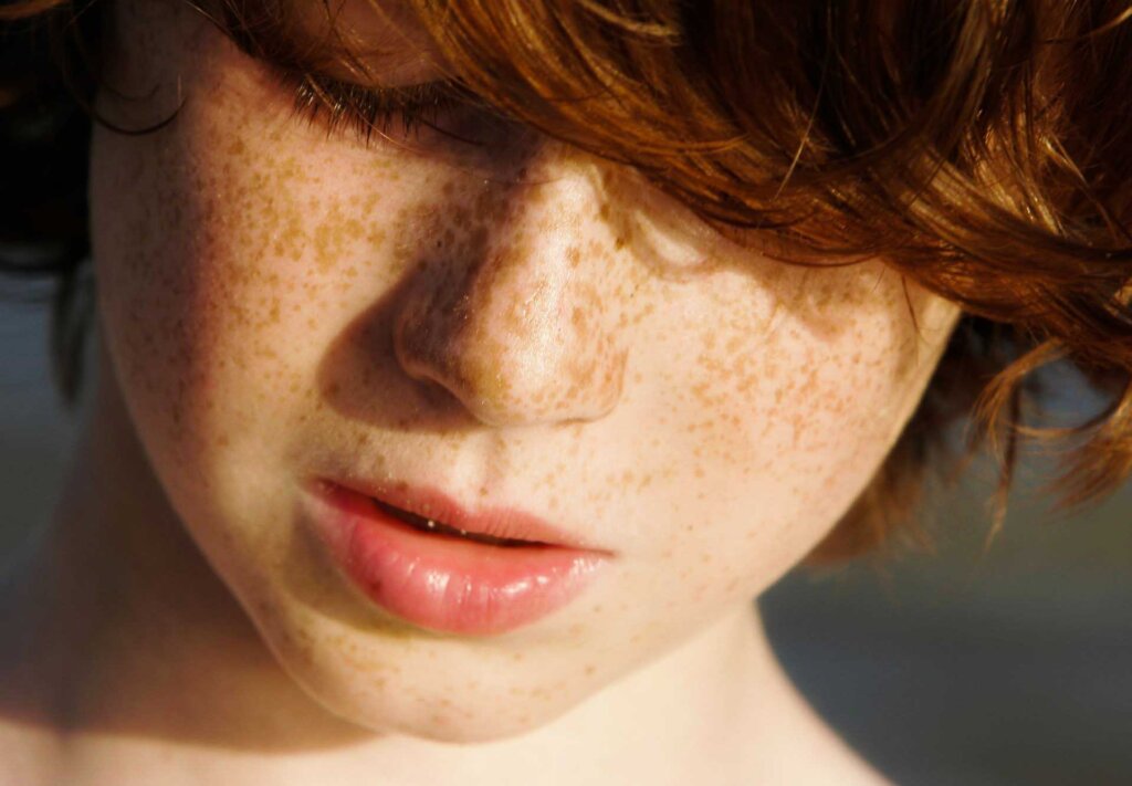 Why Infants Don't Have Freckles