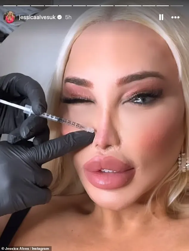 The reality star, who has had more than 100 procedures and spent over £1million on comestic surgery, had her botox and hydraulic acid 'topped up' as she took to Instagram to document the procedure